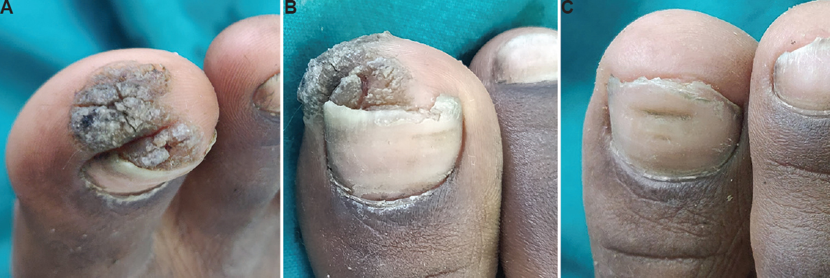 (A) Periungual warts over right great toe (baseline). (B) Serial improvement following second dose of vitamin D3. (C) Complete resolution with reappearance of skin markings four weeks after the third injection.